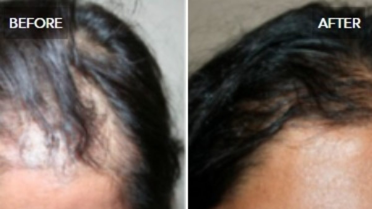 Hair Restoration options for hair loss- Dr. Stephen Giordano