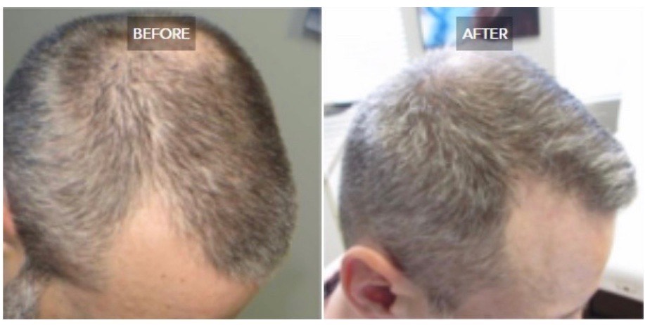 Hair restoration for men with male pattern baldness in Huntersville NC