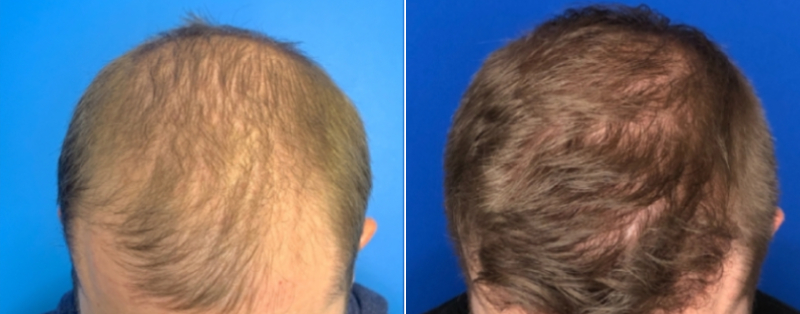 Hair Restoration Huntersville , Hair Transplantation, Beard Transplant